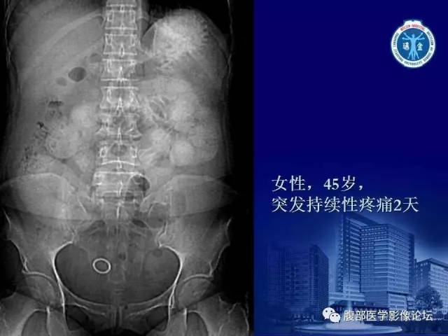 【PPT】绞窄性肠梗阻CT诊断