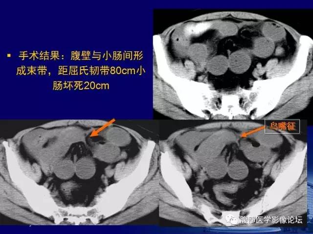 【PPT】绞窄性肠梗阻CT诊断