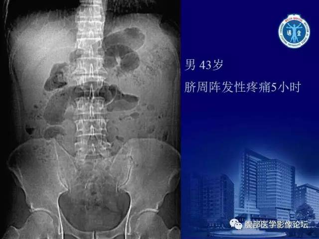 【PPT】绞窄性肠梗阻CT诊断