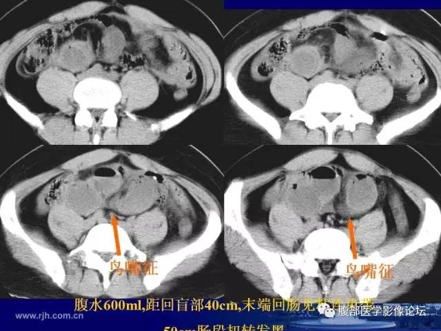【PPT】绞窄性肠梗阻CT诊断