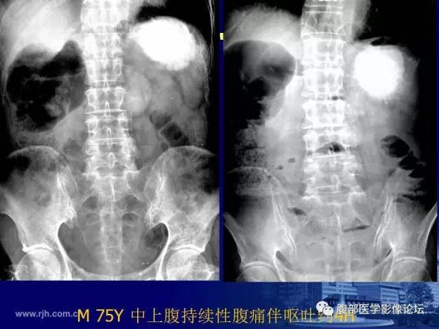 【PPT】绞窄性肠梗阻CT诊断