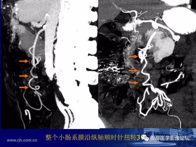 【PPT】绞窄性肠梗阻CT诊断