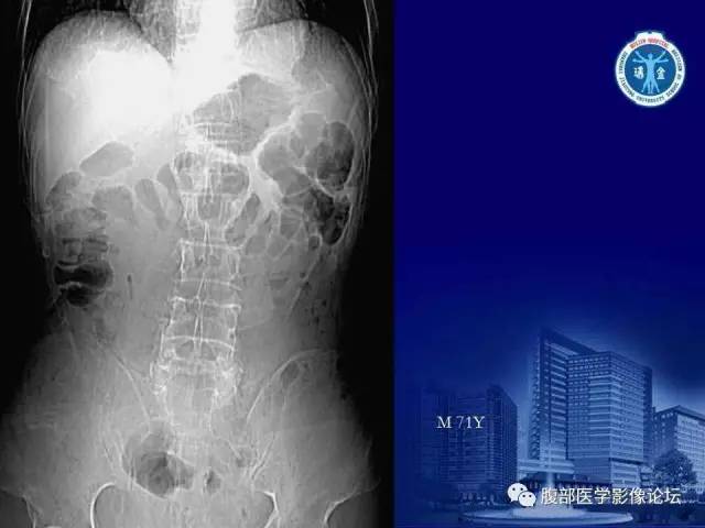 【PPT】绞窄性肠梗阻CT诊断