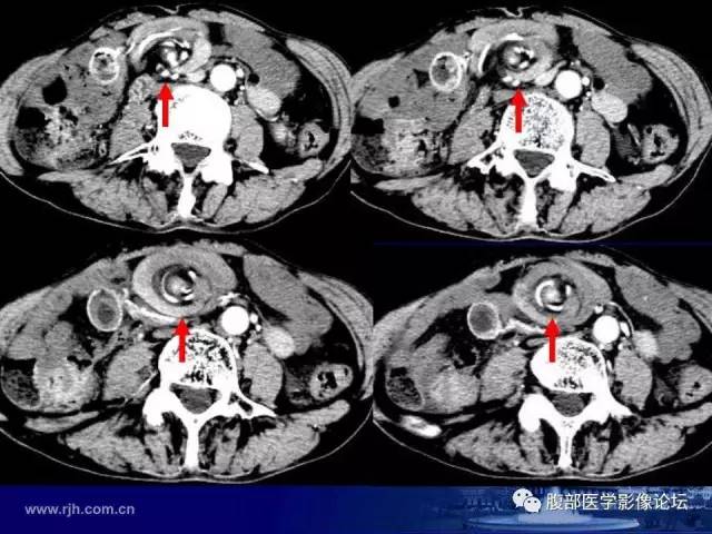 【PPT】绞窄性肠梗阻CT诊断