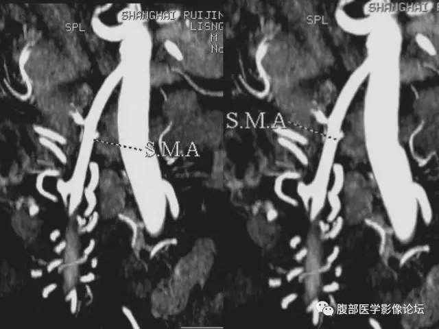 【PPT】绞窄性肠梗阻CT诊断