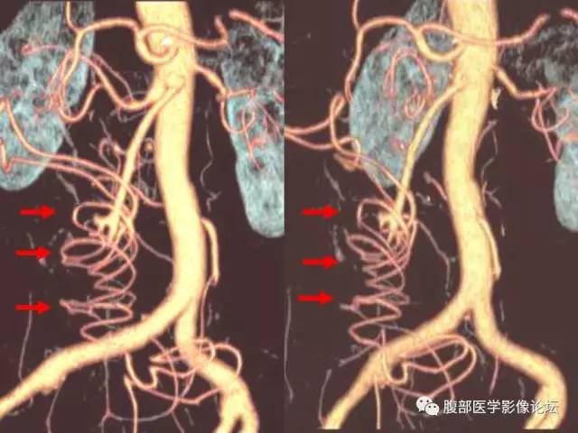 【PPT】绞窄性肠梗阻CT诊断