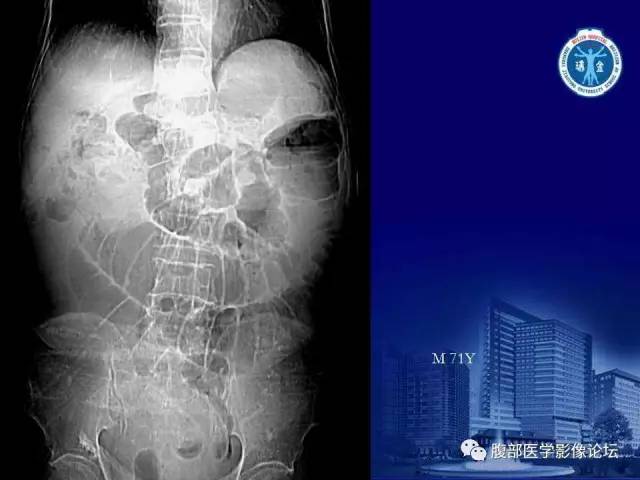 【PPT】绞窄性肠梗阻CT诊断
