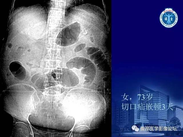 【PPT】绞窄性肠梗阻CT诊断