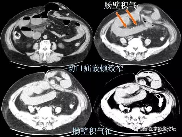 【PPT】绞窄性肠梗阻CT诊断
