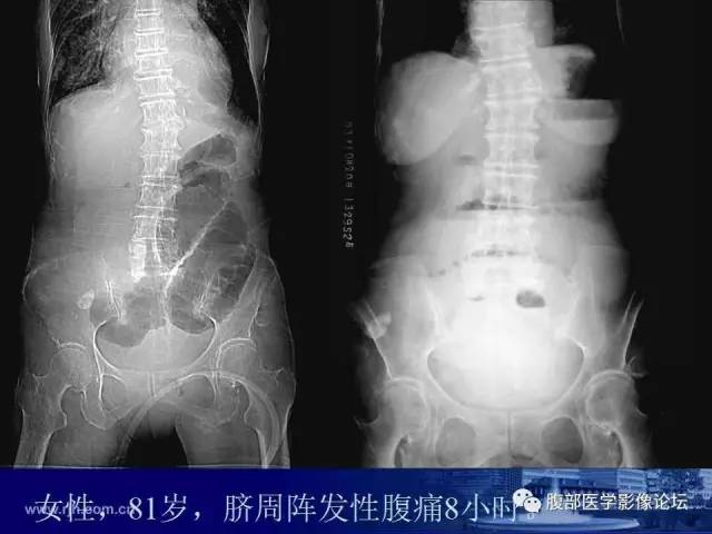 【PPT】绞窄性肠梗阻CT诊断