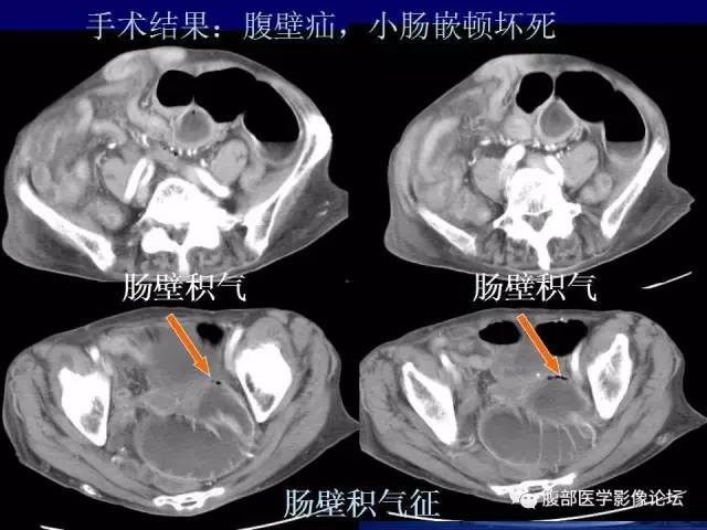 【PPT】绞窄性肠梗阻CT诊断