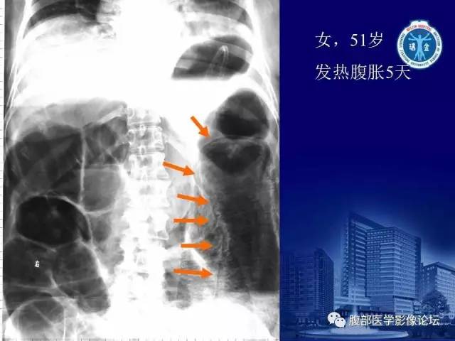 【PPT】绞窄性肠梗阻CT诊断