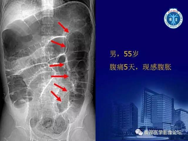 【PPT】绞窄性肠梗阻CT诊断