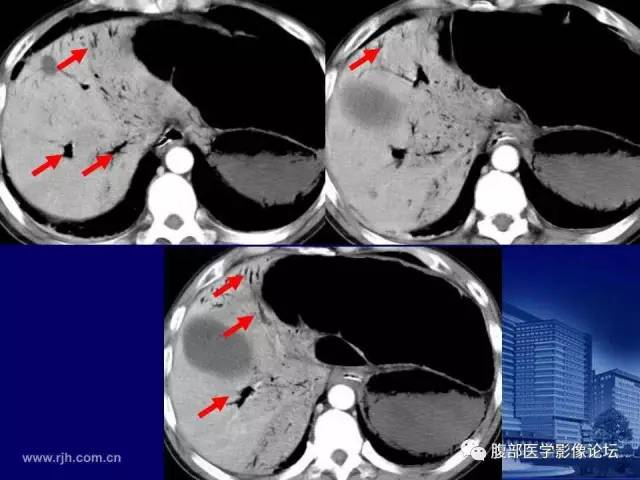 【PPT】绞窄性肠梗阻CT诊断
