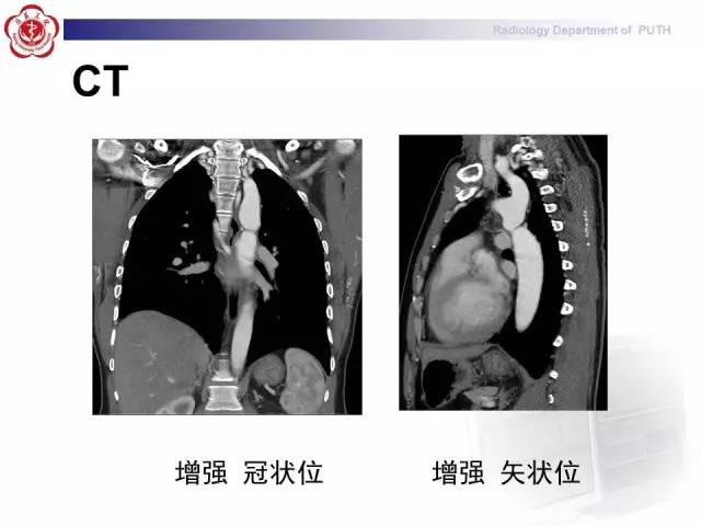 【病例】主动脉缩窄1例CT影像表现