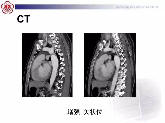 【病例】主动脉缩窄1例CT影像表现