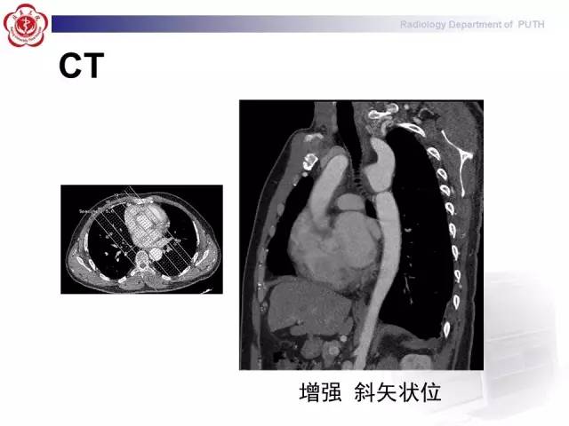 【病例】主动脉缩窄1例CT影像表现