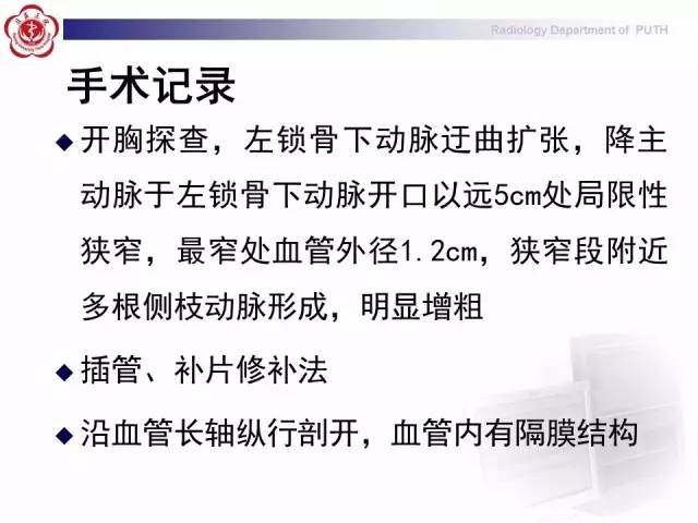 【病例】主动脉缩窄1例CT影像表现