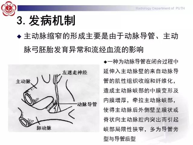 【病例】主动脉缩窄1例CT影像表现