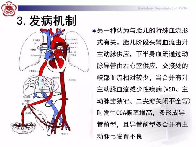 【病例】主动脉缩窄1例CT影像表现