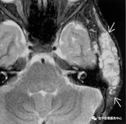 八种头皮肿块，肯定有你不知道的