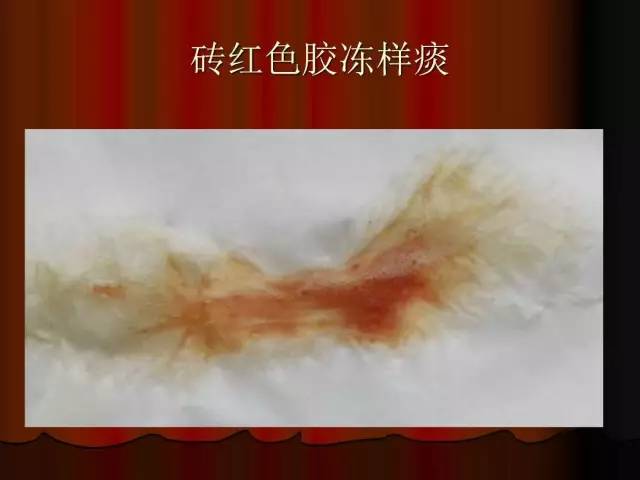【PPT】肺炎克雷白杆菌肺炎影像学表现