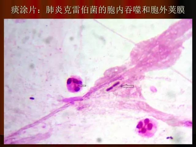【PPT】肺炎克雷白杆菌肺炎影像学表现