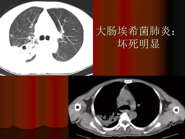 【PPT】肺炎克雷白杆菌肺炎影像学表现