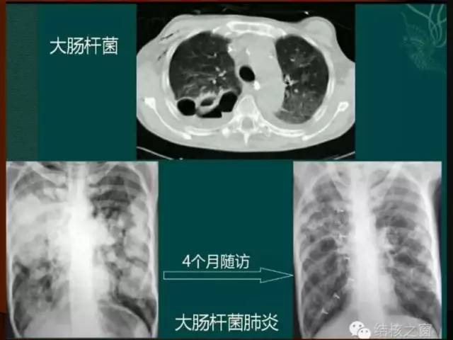 【PPT】肺炎克雷白杆菌肺炎影像学表现