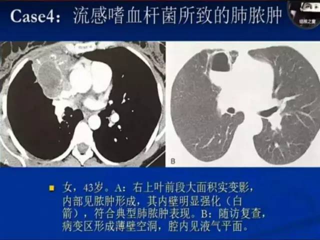 【PPT】肺炎克雷白杆菌肺炎影像学表现