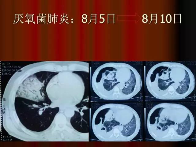 【PPT】肺炎克雷白杆菌肺炎影像学表现