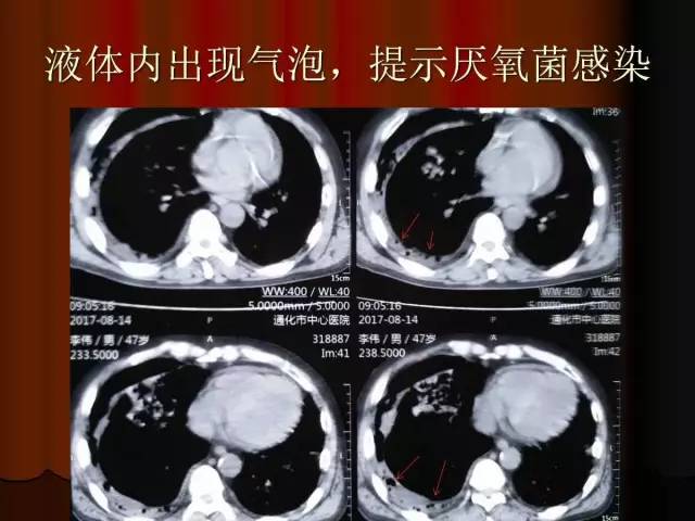 【PPT】肺炎克雷白杆菌肺炎影像学表现