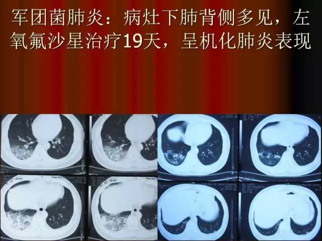 【PPT】肺炎克雷白杆菌肺炎影像学表现