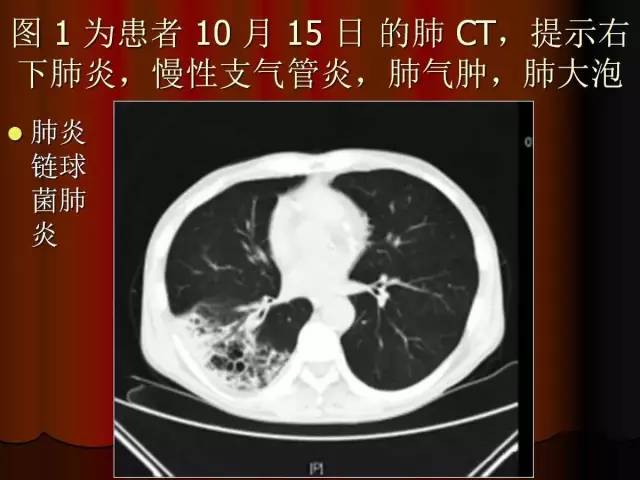 【PPT】肺炎克雷白杆菌肺炎影像学表现