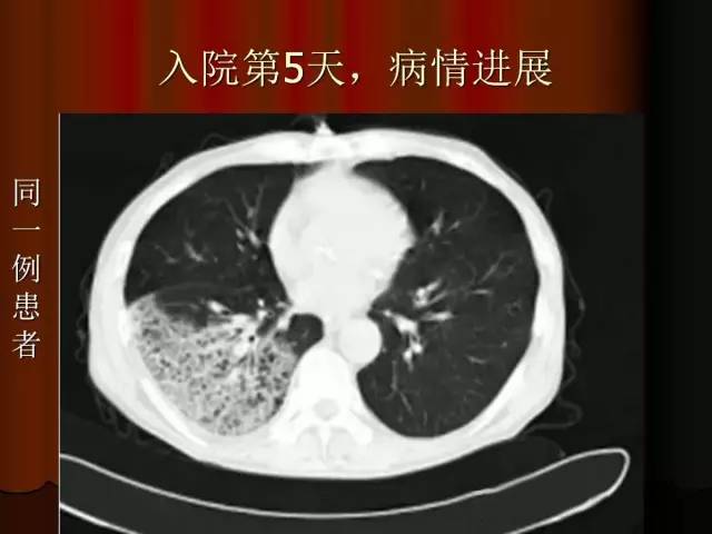 【PPT】肺炎克雷白杆菌肺炎影像学表现