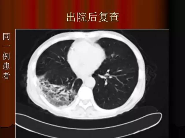 【PPT】肺炎克雷白杆菌肺炎影像学表现