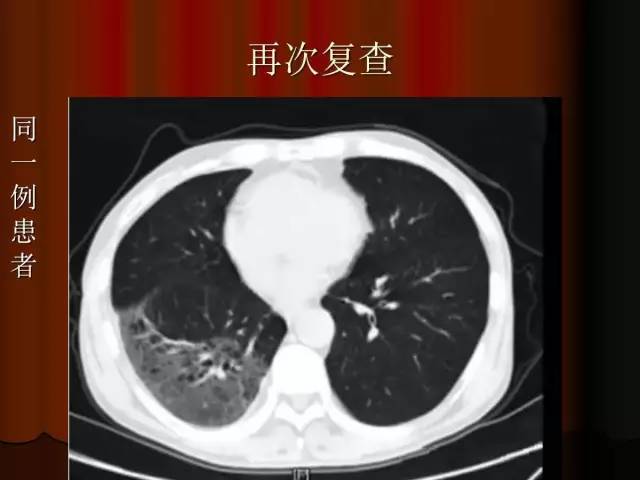 【PPT】肺炎克雷白杆菌肺炎影像学表现