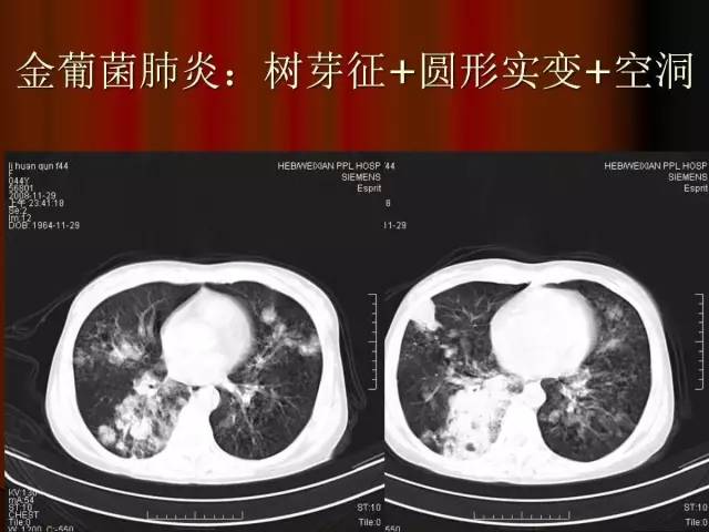 【PPT】肺炎克雷白杆菌肺炎影像学表现