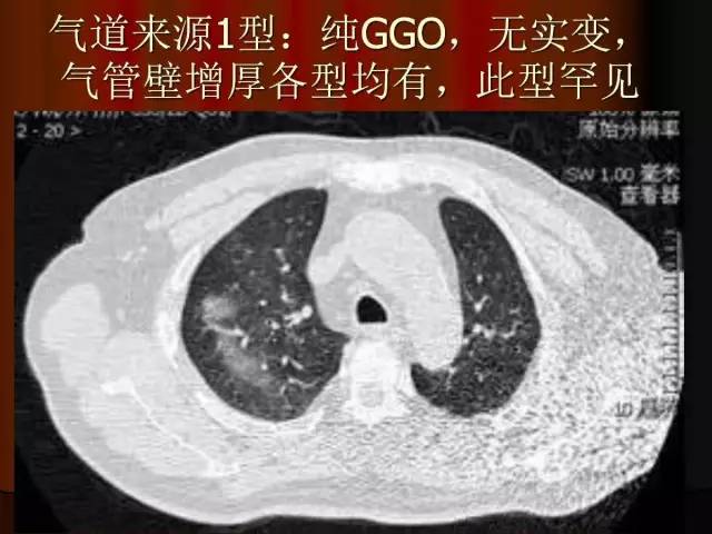 【PPT】肺炎克雷白杆菌肺炎影像学表现