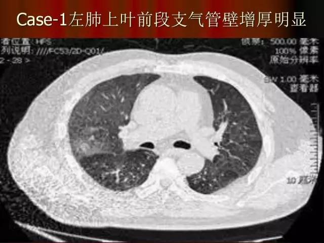 【PPT】肺炎克雷白杆菌肺炎影像学表现