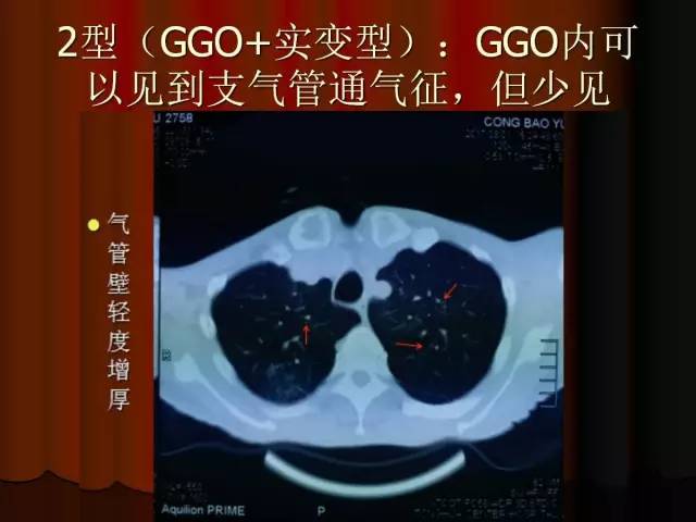 【PPT】肺炎克雷白杆菌肺炎影像学表现