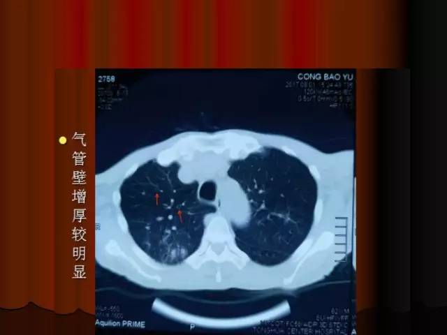 【PPT】肺炎克雷白杆菌肺炎影像学表现