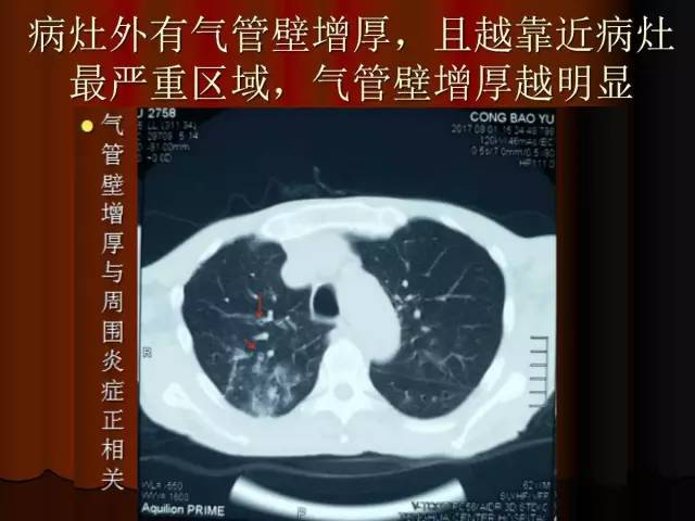 【PPT】肺炎克雷白杆菌肺炎影像学表现