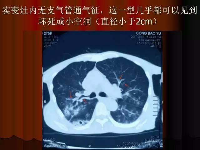 【PPT】肺炎克雷白杆菌肺炎影像学表现