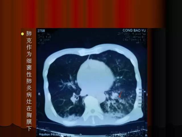 【PPT】肺炎克雷白杆菌肺炎影像学表现