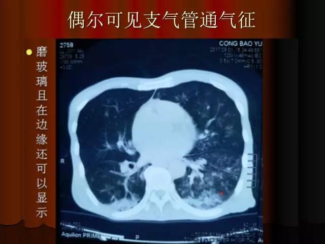 【PPT】肺炎克雷白杆菌肺炎影像学表现