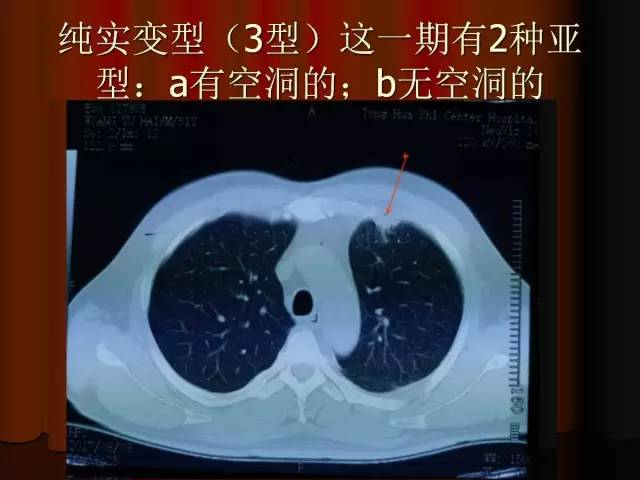 【PPT】肺炎克雷白杆菌肺炎影像学表现