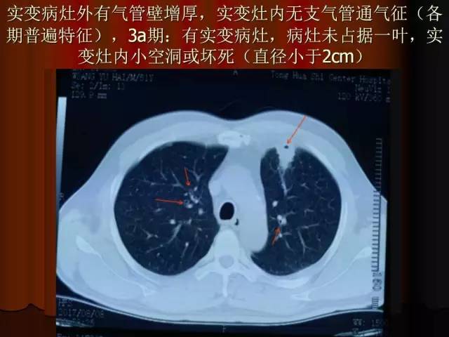 【PPT】肺炎克雷白杆菌肺炎影像学表现