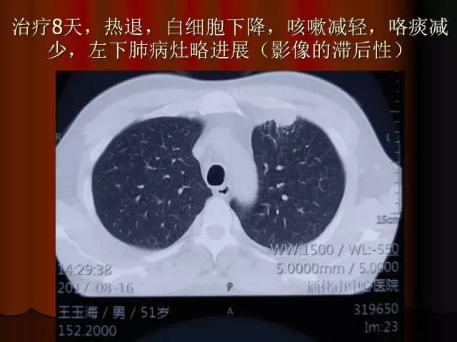 【PPT】肺炎克雷白杆菌肺炎影像学表现