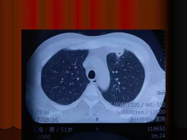 【PPT】肺炎克雷白杆菌肺炎影像学表现